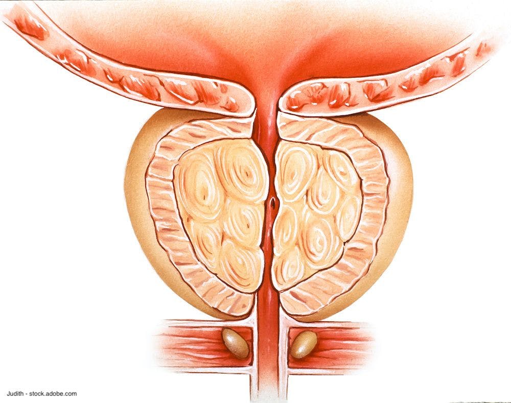 PINNACLE trial aims to confirm pilot success with BPH drug-coated balloon catheter